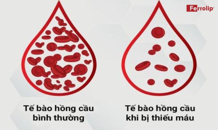nguyên nhân thiếu máu 3 tháng đầu
